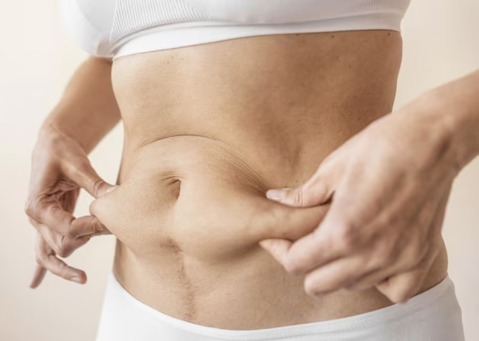 tummy-tuck-4