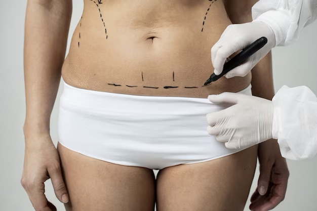 liposuction